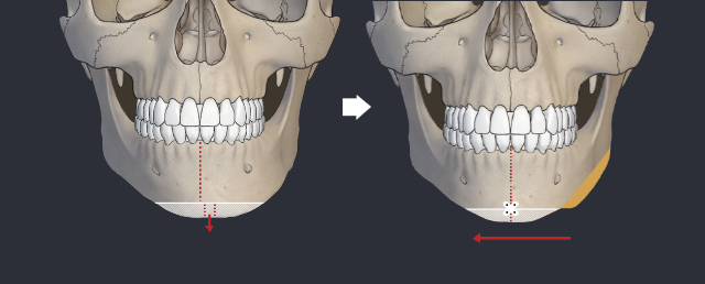 이유구강악안면외과치과의원 Orthognathic Surgery > Facial Asymmetry